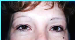 eyelid lift