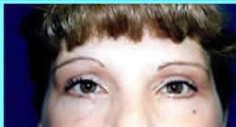 eyelid lift