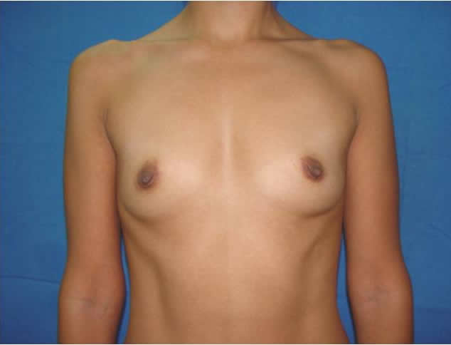 breast enlargement