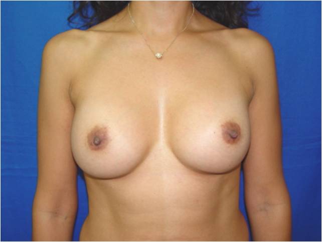 breast augmentation