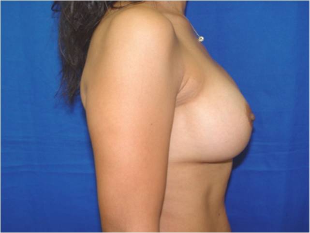 anatomical breast implants