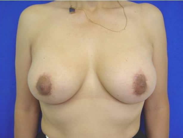 breast lift