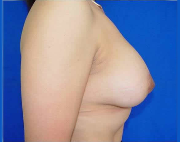 breast lift