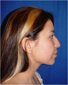 rhinoplasty