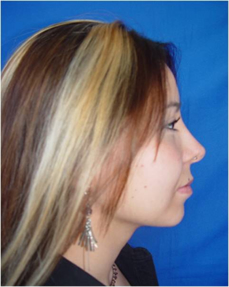 rhinoplasty